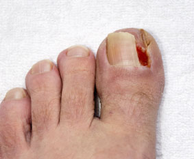 ingrown toenail in the Easton, PA 18042 and Northampton, PA 18067 area