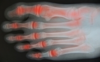 Arthritis Can Affect the Feet and Ankles