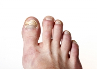 Fungi That Cause Toenail Infections 