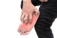 Is Athlete’s Foot Contagious?